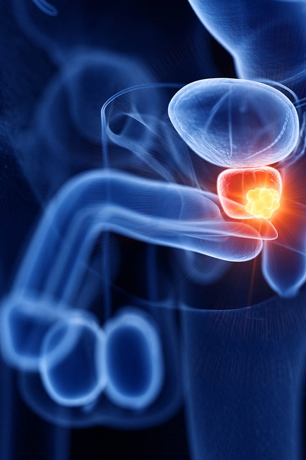 Passerini se sometió a una prostatectomía radical.