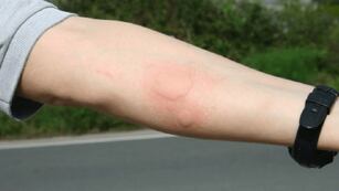 Picaduras de alacranes