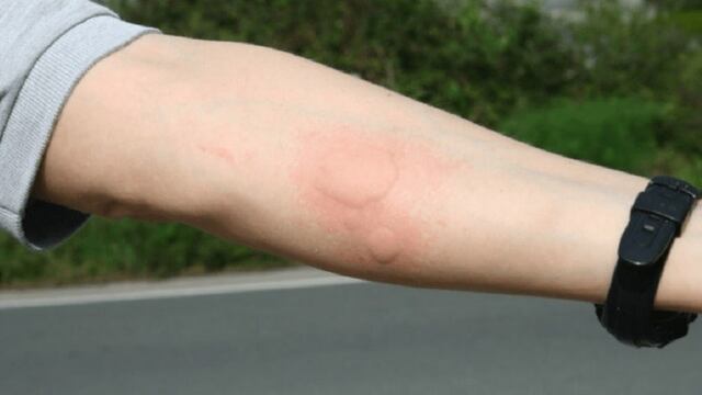 Picaduras de alacranes