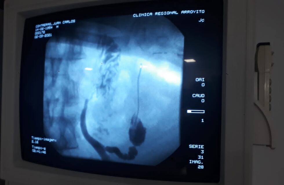 Histórico: se realizó por primera vez en Arroyito una CPRE en la Clínica Regional