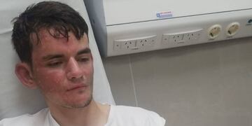 Alexis Deabreu Leguizamón se recupera en el Instituto del Quemado del Británico