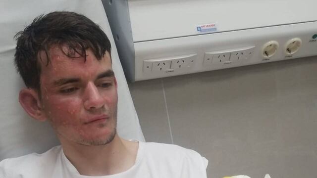 Alexis Deabreu Leguizamón se recupera en el Instituto del Quemado del Británico