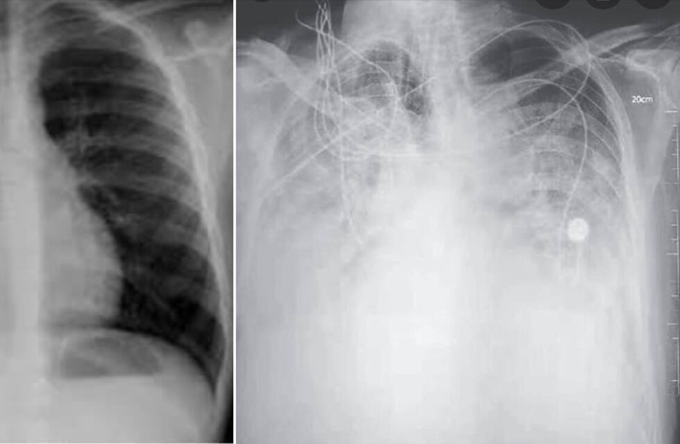 “Que seas joven no te hace inmune”, el fuerte mensaje de una médica del Pintos sobre el coronavirus