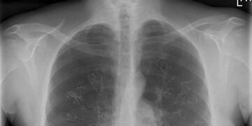 El 17 de noviembre se conmemora el Día Internacional de la Lucha contra el Cáncer de Pulmón, una de las principales causas de muerte en todo el mundo  (AP / Archivo).