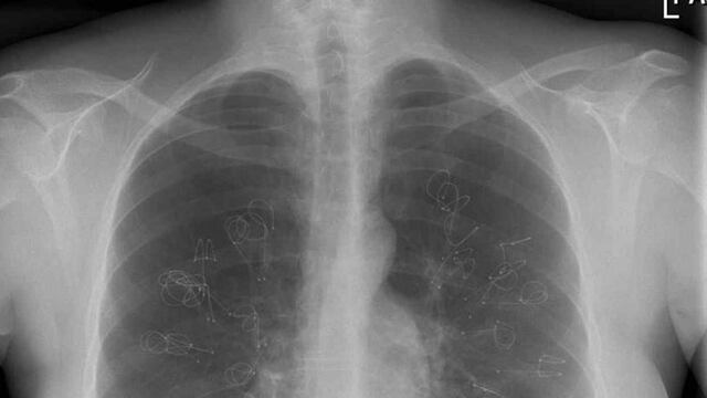 El 17 de noviembre se conmemora el Día Internacional de la Lucha contra el Cáncer de Pulmón, una de las principales causas de muerte en todo el mundo  (AP / Archivo).