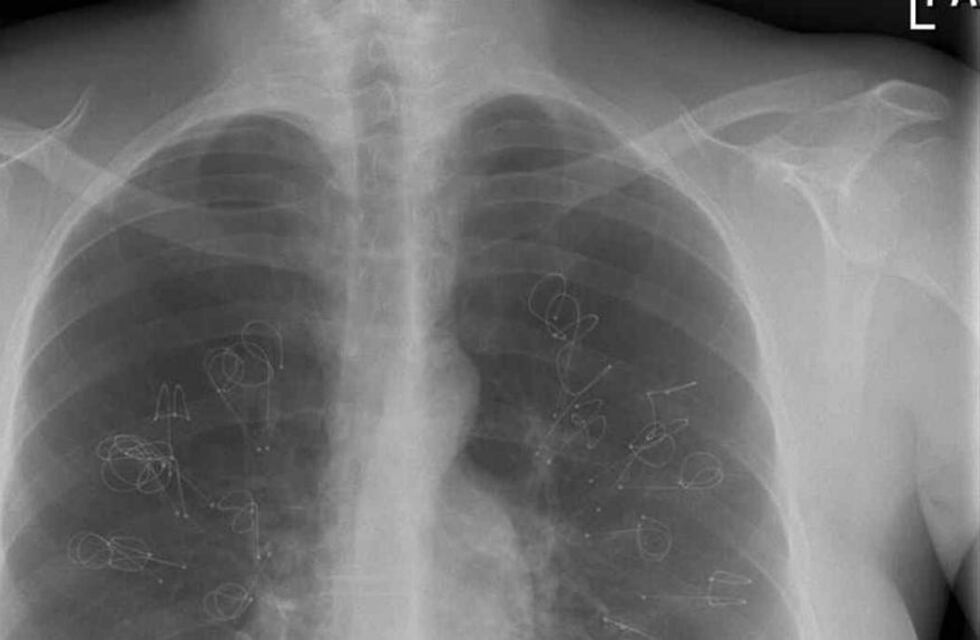 Día Internacional de la Lucha contra el Cáncer de Pulmón: por qué se conmemora un 17 de noviembre y cómo prevenirlo