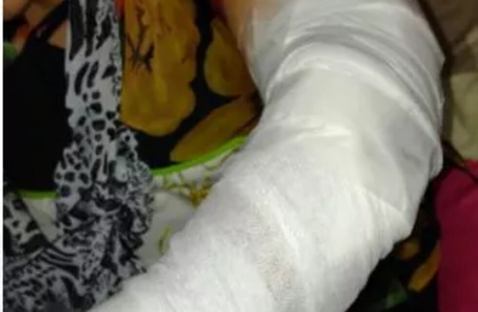 El perro de su hermana la mordió y debió ser asistida