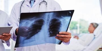 La neumonía es una infección del pulmón y el tipo más común es la producida por una bacteria denominada Neumococo. / Sanatorio Allende