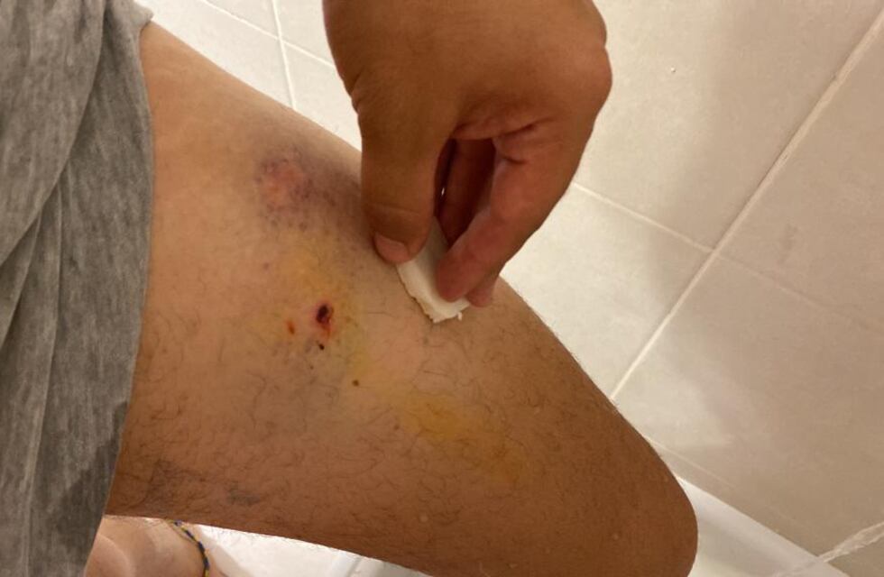 Ataques de un pitbull: ¿Qué dice la ordenanza de perros potencialmente peligrosos de Rafaela?