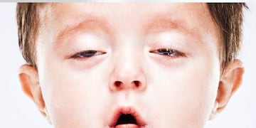 Síndrome de Kartagener (imagen ilustrativa).