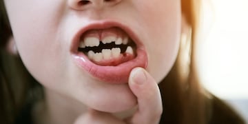 Insólito caso de una niña que se volvió viral por tener 81 dientes | Imagen Referencial.