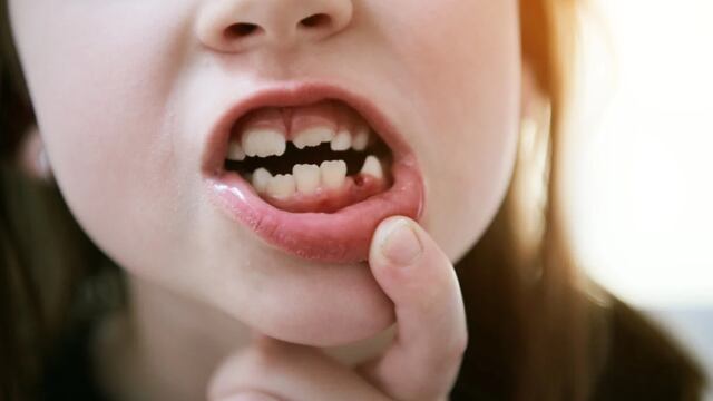 Insólito caso de una niña que se volvió viral por tener 81 dientes | Imagen Referencial.
