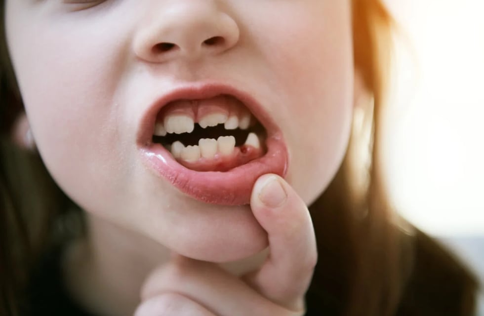 El insólito caso de una niña que se volvió viral por tener 81 dientes