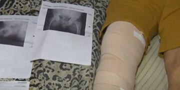 Tomás Córdoba asegura que fue víctima de una confusión, había otro paciente con el mismo apellido al que le tenían que poner una prótesis de rodilla.