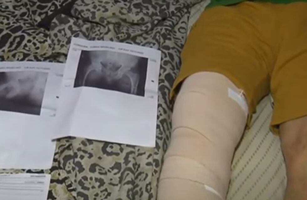 Escándalo en Córdoba: denunció a los médicos que lo operaron por error de la rodilla