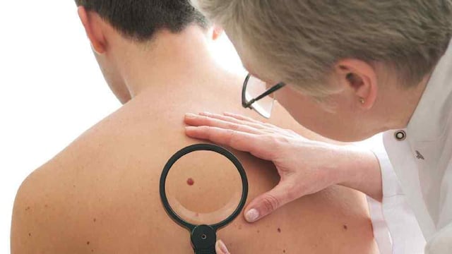 Cáncer de piel. Realizan controles gratuitos en le hospital Schestakow.
