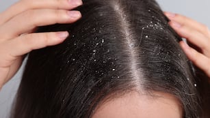 Los trucos para eliminar la caspa por completo.