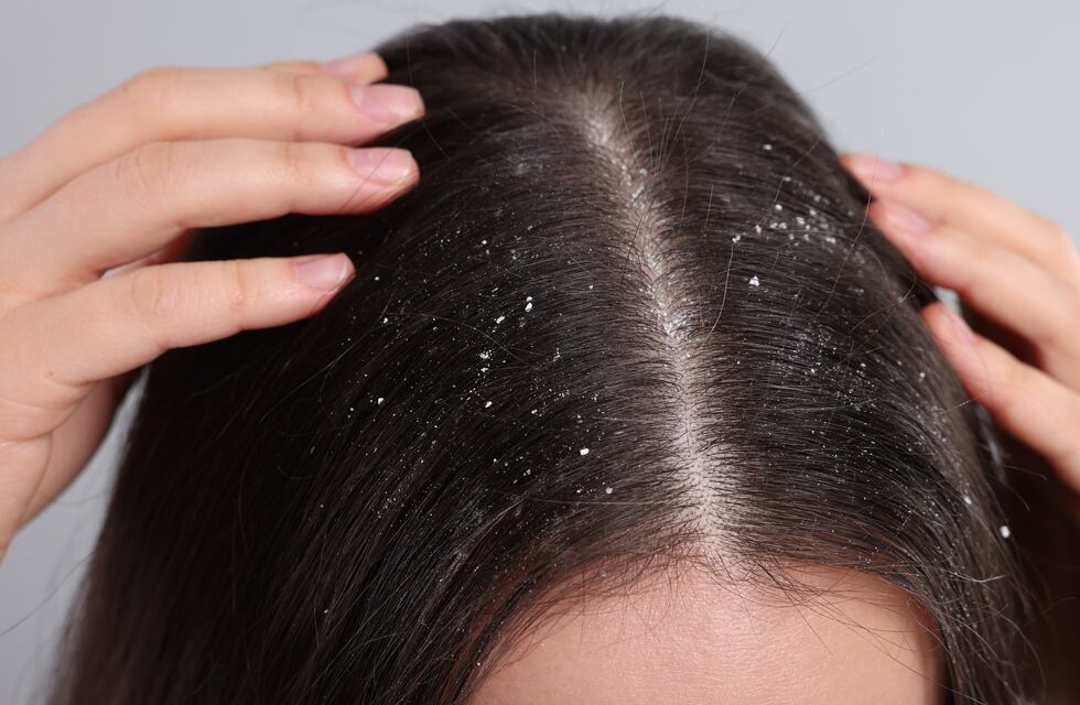 Adiós a la caspa: 7 trucos caseros que la eliminarán por completo del cabello