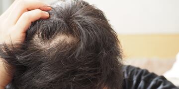 Una posible solución para la falta de cabello. (imagen ilustrativa)