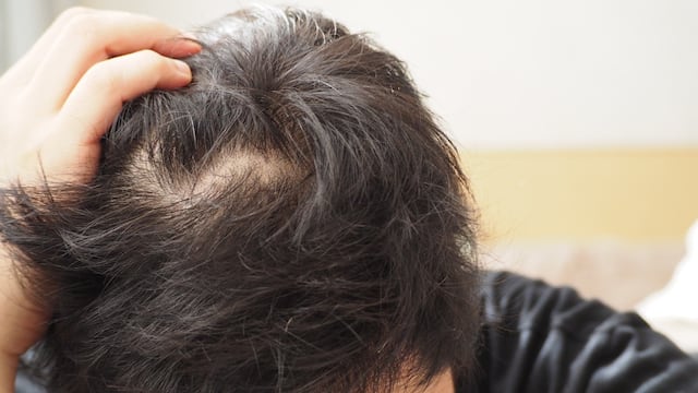 Una posible solución para la falta de cabello. (imagen ilustrativa)