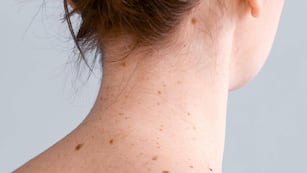 Realizarán chequeos gratuitos de lunares con tecnología de IA en Buenos Aires. (Gentileza)