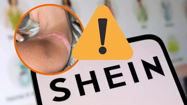 Compró un top en Shein por $7.000 y terminó con una quemadura que podría dejarle cicatriz