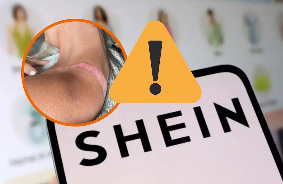 Compró un top en Shein por $7.000 y terminó con una quemadura que podría dejarle cicatriz