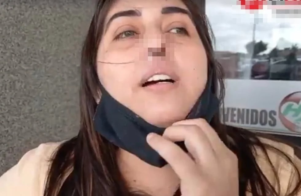 Una mujer perdió el cartílago de la nariz por un PCR mal realizado