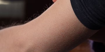 Por qué se produce la queratosis pilaris y cómo combatir “la piel de gallina”, según los expertos