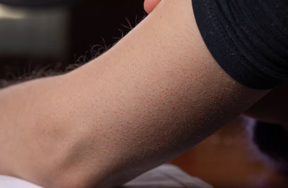 Por qué se produce la queratosis pilaris y cómo combatir “la piel de gallina”, según los expertos