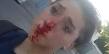 Martina Vallejos, de 13 años, con la nariz ensangrentada por el golpe de su agresor.