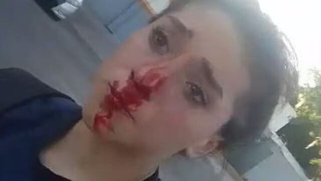 Martina Vallejos, de 13 años, con la nariz ensangrentada por el golpe de su agresor.