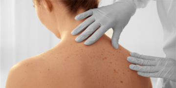 El melanoma es el tipo más grave de cáncer de piel. (sanatorio Allende)
