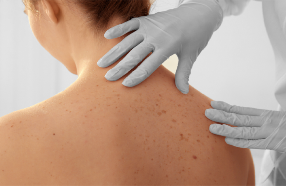 Qué es el melanoma, el cáncer de piel que le diagnosticaron a Pilar Smith