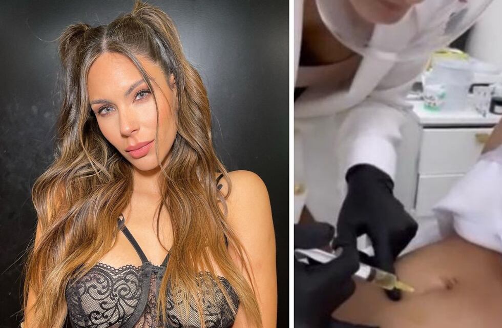 Barby Franco lo usa en su cicatriz de la cesárea: qué son las inyecciones de plasma rico en plaquetas y para qué sirven