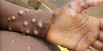 Las lesiones cutáneas producidas por la viruela del mono son uno de los muchos síntomas.