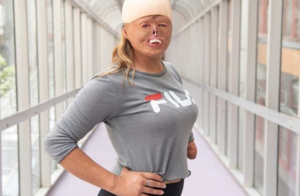 Brisa: la salteña que a los 7 meses se quemó el 90% de su cuerpo y hoy es deportista y modelo