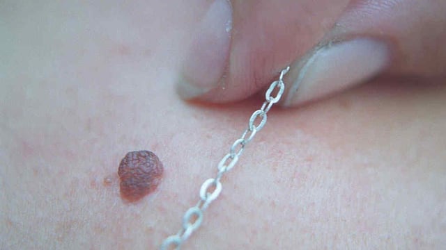 LUNAR. Esta semana se harán controles de piel en el Hospital San Roque (La Voz / Archivo).