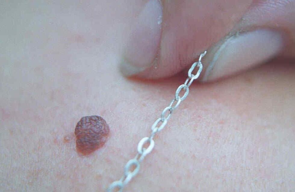 Punta Alta: jornada de control de lunares, manchas, verrugas y la aparición de bultos