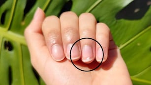 Qué significa que me salgan manchas blancas en las uñas.