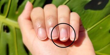 Qué significa que me salgan manchas blancas en las uñas.