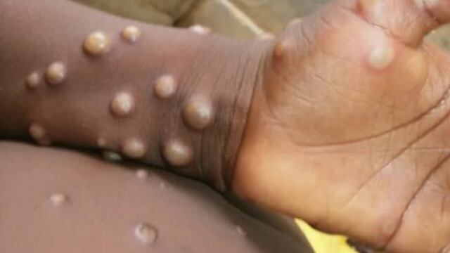 Viruela del mono. Así son algunos síntomas de esta extraña enfermedad. (Foto / OMS)