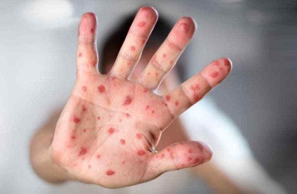 Un caso de una mujer que podría ser sarampión, despierta la alerta epidemiológica en Argentina