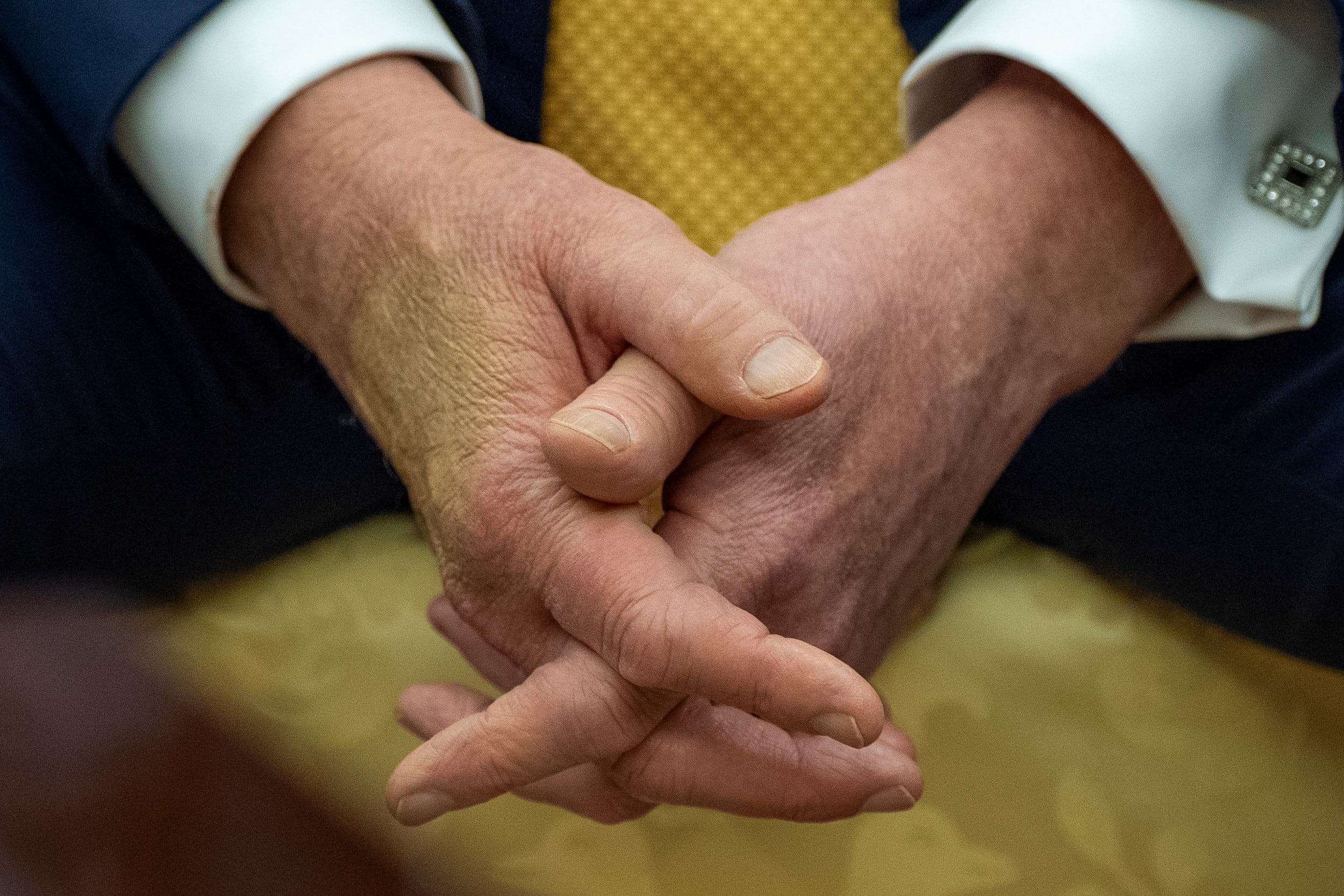 Moretones en la mano de Trump
