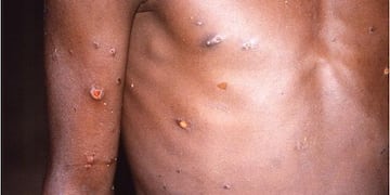 Bélgica es el primer país europeo en imponer cuarentena a los pacientes con diagnósitco confirmado.