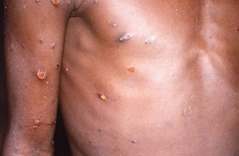 Viruela del mono: la palabra del director del Hospital Rawson de Córdoba