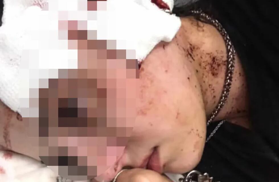 Desgarrador testimonio de la moza agredida en un bar de Mendoza: “Me destrozaron la vida”