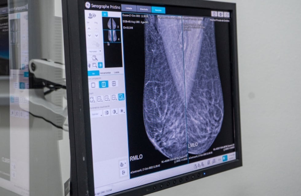 Córdoba: el cáncer de mama es curable en el 90% de los casos detectados de manera temprana