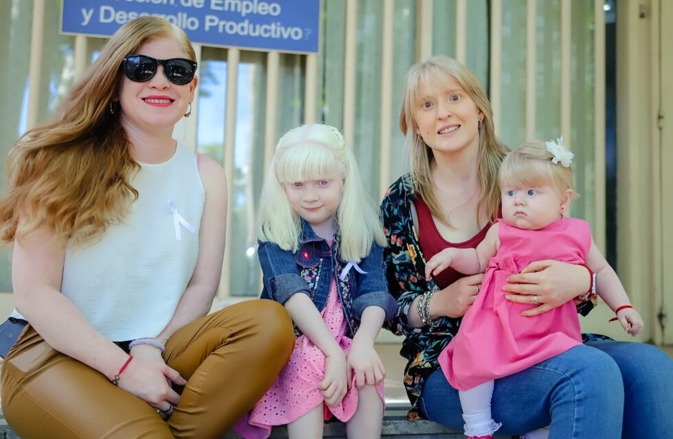 La lucha de una mujer albina sanjuanina y el sueño de crear una organización