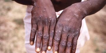 Viruela del mono. Foto: Brian W.J. Mahy / Centers for Disease Control and Prevention / AFP.